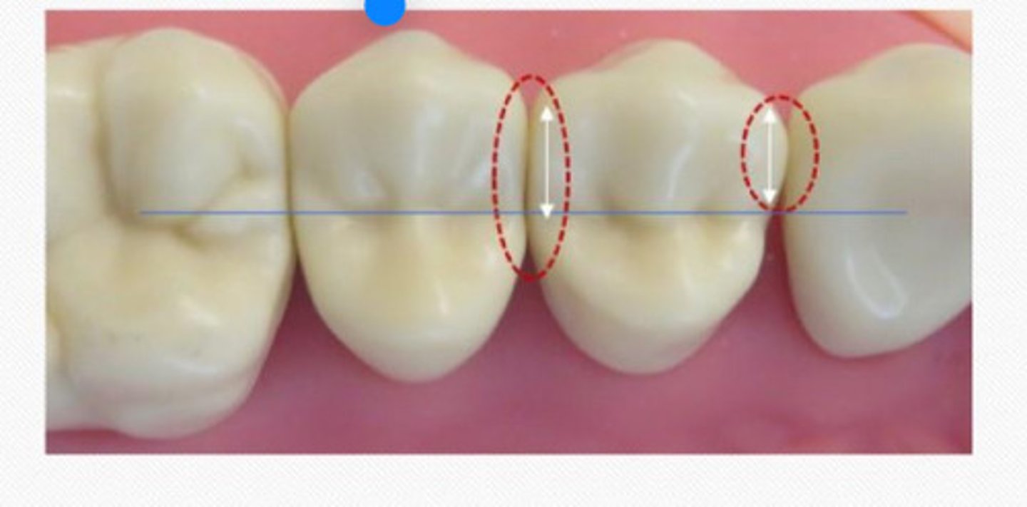 <p>In maxillary first premolars The mesial contact is more __ placed and __ in size than the distal contact</p>