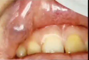 <p>Where might you find Canalicular Adenoma?</p>