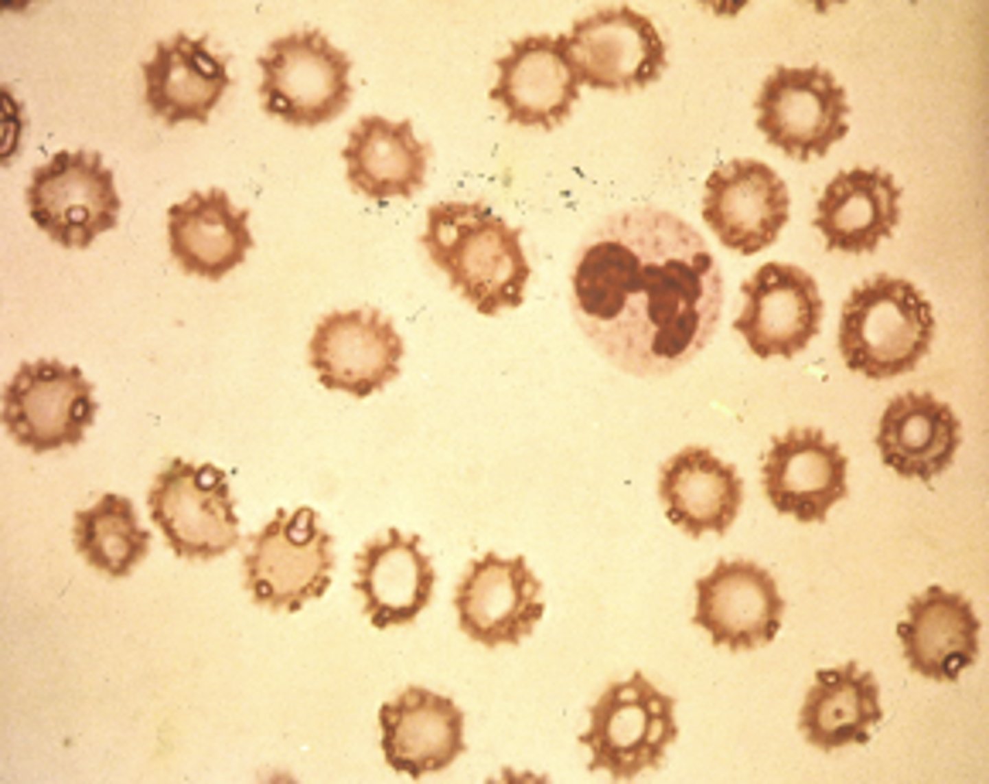 <p>- Due to lab error</p><p>- Stain must be changed</p><p>-Appears moth-eaten</p>
