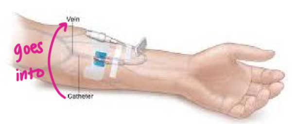 <p>IV access through a vein, generally in the hand, arm, foot, and sometimes the scalp</p>