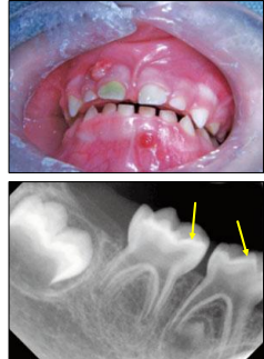<ul><li><p>large pulp horns extending to DEJ </p></li><li><p>multiple non-vital teeth </p></li><li><p>absence of caries or trauma </p></li></ul><p></p>