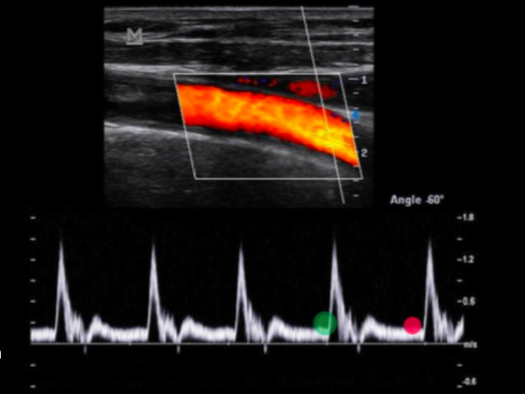 <p>Use your cursor to measure the end diastolic velocity of the third waveform. Use your mouse to position the cursor and click to set your answer.</p><p></p><p></p>