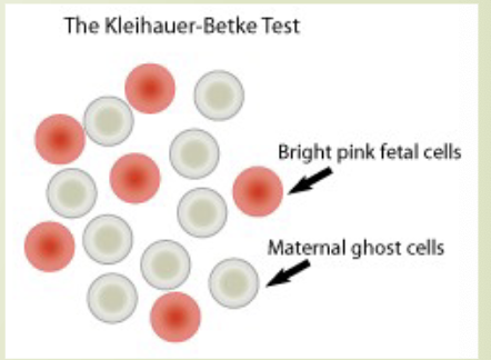 <ul><li><p>maternal blood is treated with acid</p><ul><li><p>fetal cells have higher HGB F and are more resistance to acid elution</p></li><li><p>fetal cells remain intact and are red</p></li><li><p>maternal cells lose hgb and appear as ghost cells</p></li></ul></li></ul><p></p>