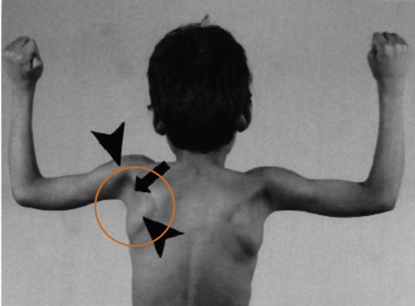 <p>"valleys" below armpits indicates Duchenne MD</p>