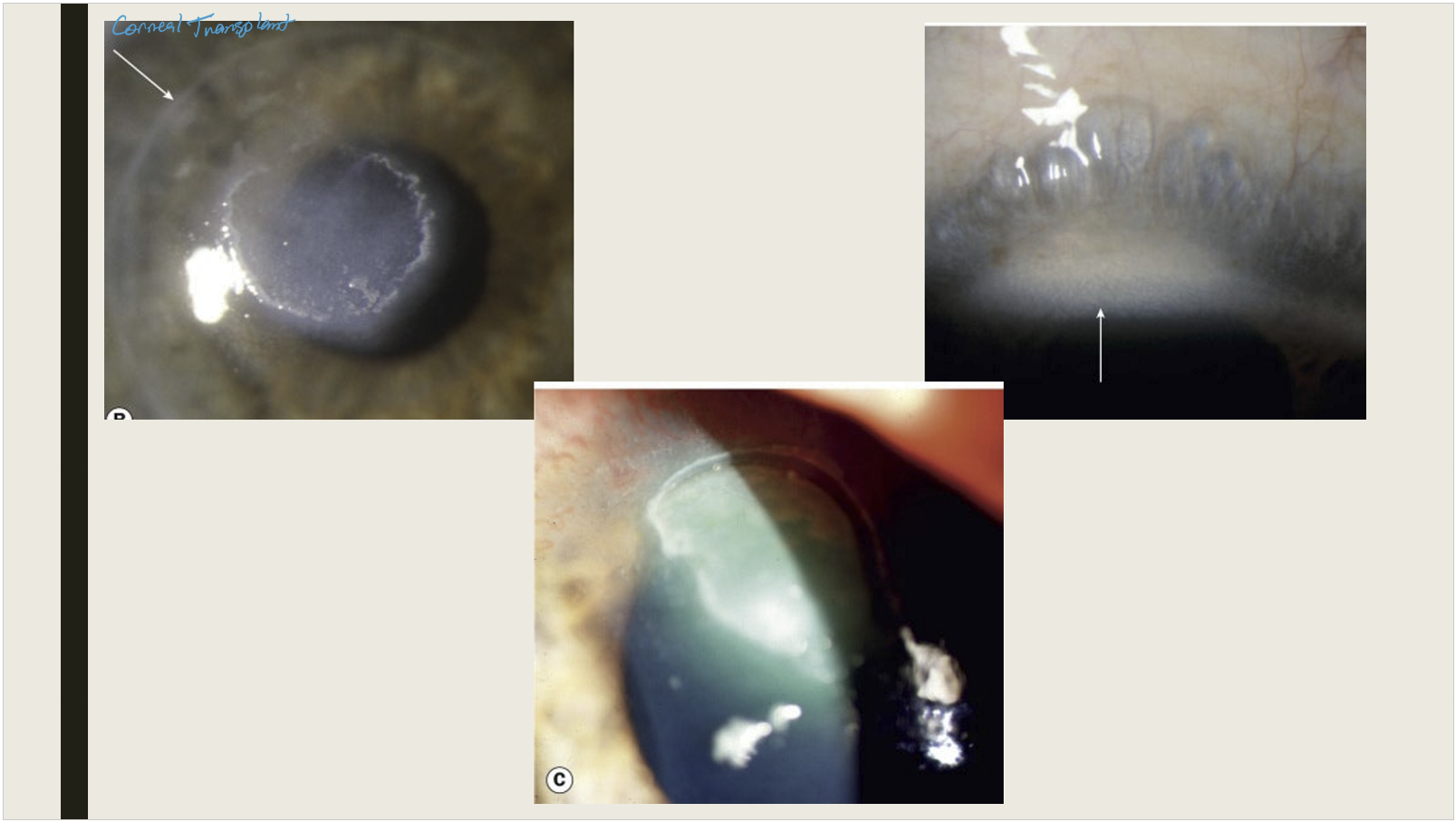 <ul><li><p>Superior PEE, associated with sheets of mucus</p></li><li><p>Epithelial macroerosions d/t coalesced PEE, inflammatory mediators, and mechanical injury d/t superior tarsal papillae</p></li><li><p>Plaques and shield ulcers: plaques composed of fibrin and mucus and collect on macroerosions and form shield ulcers&nbsp;</p></li><li><p>Subepithelial scars: appear grey and oval, may affect vision</p></li><li><p>Pseudogerontoxon: can be seen with recurrent limbal disease, is white-grey band in anterior stroma of scarring, adjacent to area of previous limbal infection</p></li><li><p>Corneal neovascularization, tends to be superior</p></li></ul><p></p>