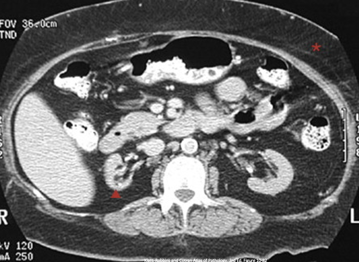 <p>What pathology is indicated with the left kidney?</p>