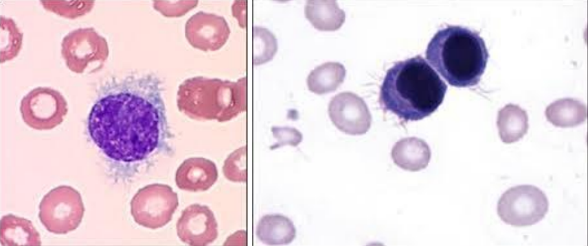 <p>Isolated in Seattle, USA in patient with “hairy cell” leukemia</p>