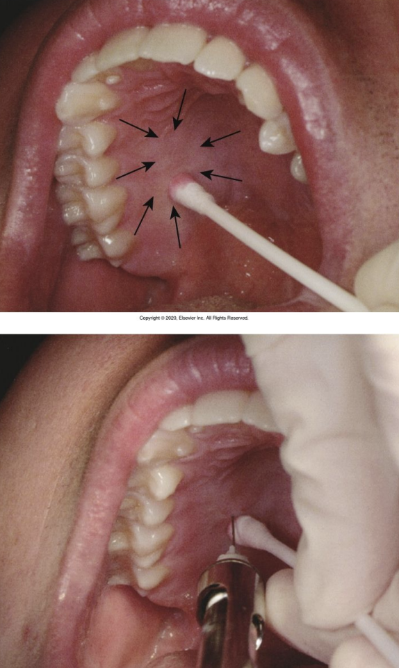 <ul><li><p>soft tissue slightly anterior to the greater palatine foramen. </p></li><li><p>Place cotton swab at junction of maxillary alveolar process and the hard palate</p></li></ul><p></p>