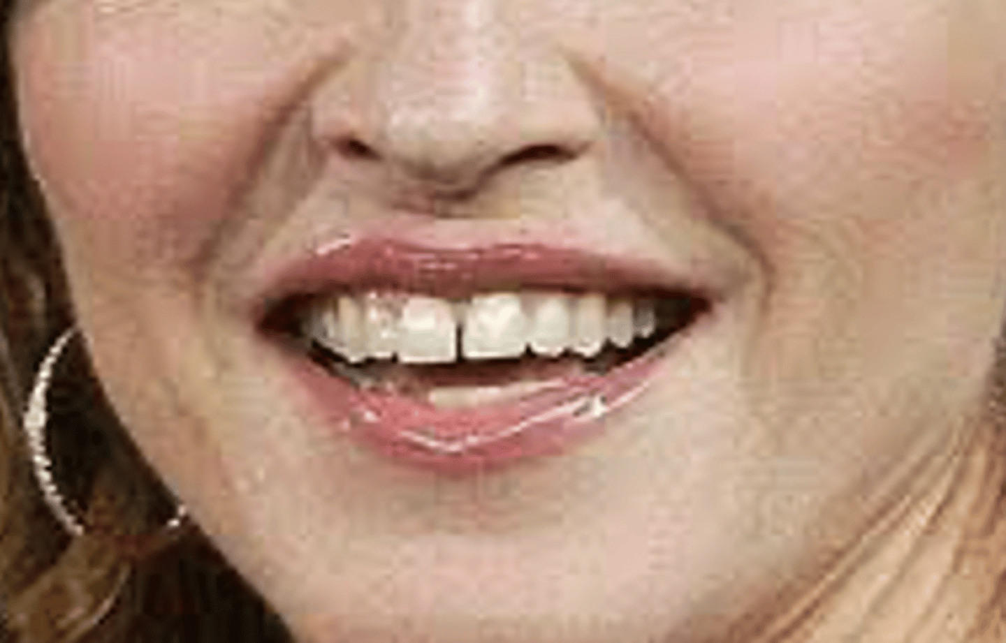 <p>abnormal space between teeth</p>