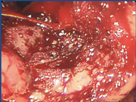 <p>What type of ulcer is this?</p>