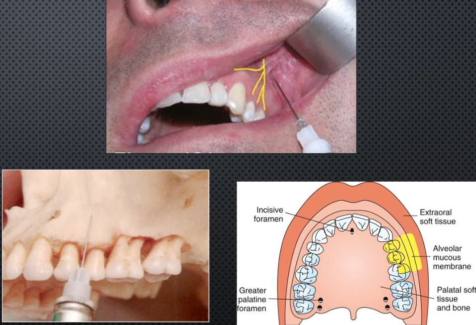 <ul><li><p>Area anesthetized: Both max premolars +MB cusp of 1st molar</p></li></ul><ul><li><p>Procedure: same as PSA but start above 2nd premolar</p></li><li><p>Onset of action: 3-5 min</p></li><li><p>Amount of anesthetic: 0.9-1.2ml</p></li></ul><p></p>