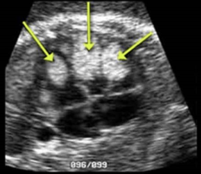 <p>which question do you <strong>ask the mother</strong> to correlate her hx w/<strong>rhabdomyoma </strong>(most common peds heart tumor)</p><p>.</p><p>a) are you diabetic</p><p>b) have you had a recent infection</p><p>c) do you have a hx of tuberous sclerosis</p><p>d) do you have prior hx of a child w/down syndrome</p>