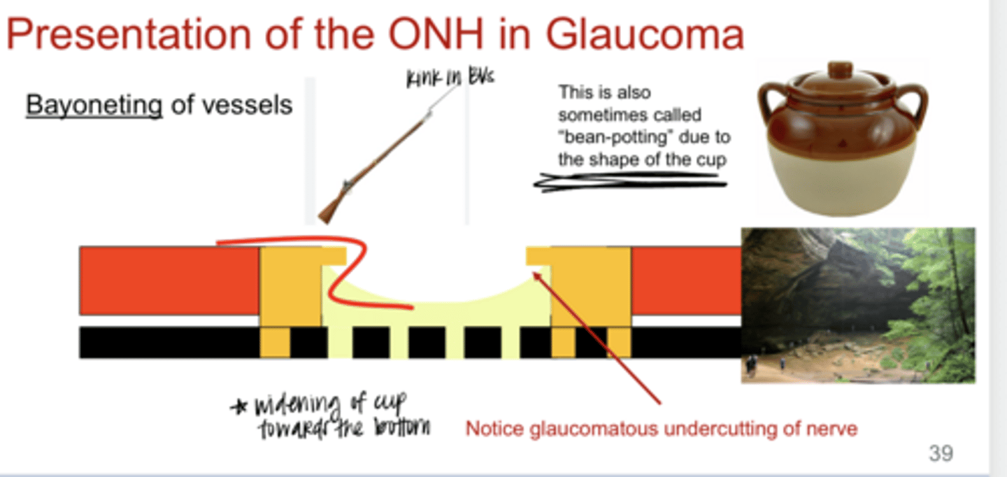 <p>Bayoneting of Vessels Diagram (Pic)</p><p>**glaucomatous undercutting of the nerve</p>