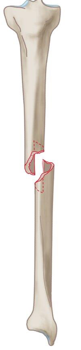 <p>what type of fracture is this?</p>