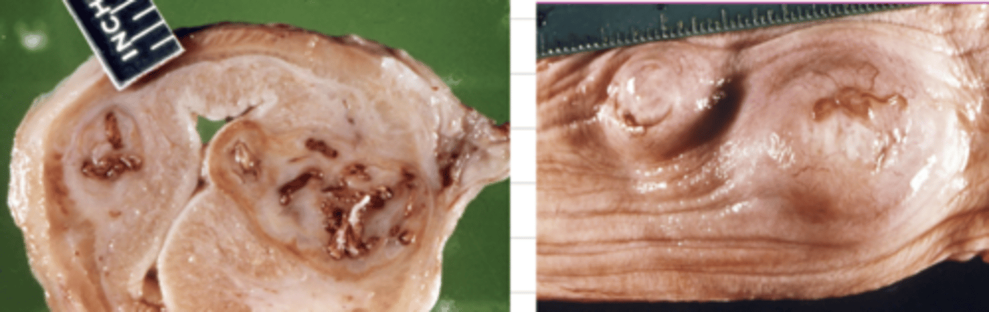 <p>what parasite has infected this esophagus? what is this disease?</p>