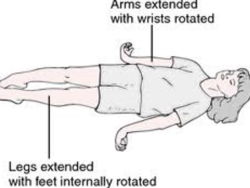 posturing in which the neck is extended with jaw clenched; arms are pronated, extended, and close to the sides; legs are extended straight out; more ominous sign of brain stem damage. Most Severe.
