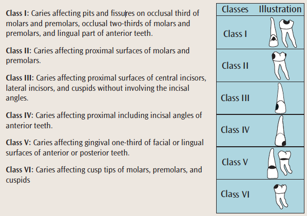 <p>Class 1- cavities in pits and fissures</p><p>Class 2- Cavities in proximal surfaces of molars and premolars</p><p>Class 3- Cavities in proximal surfaces of incisors and canines that do not involve the incisal edge</p><p>Class 4- Cavities in proximal surfaces of incisors or canines that involve the incisal edge</p><p>Class 5- Cavities in the cervical 3rd of facial or lingual surfaces (not pit or fissure)</p><p>Class 6- Cavities on incisal edges and cusps</p>