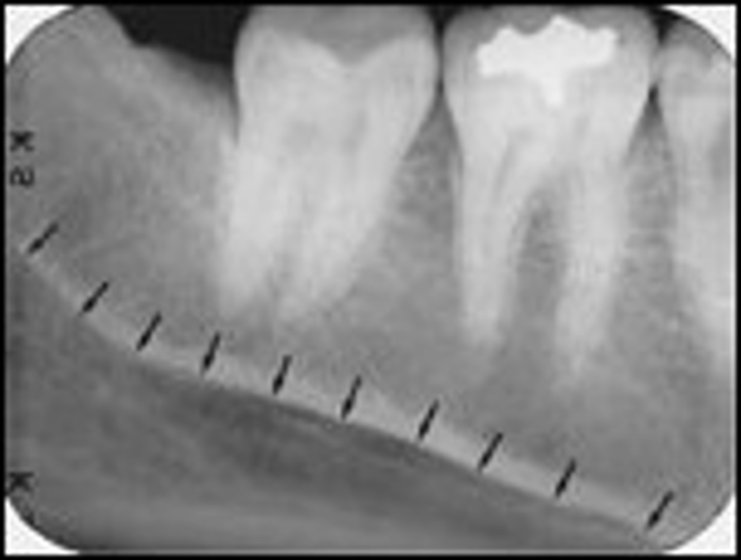 <p>rounded area of bone</p><p>less dense</p><p>space for submandibular salivary gland</p>