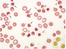 <p>Denatured Hgb (only viisble with supravital stain)</p>