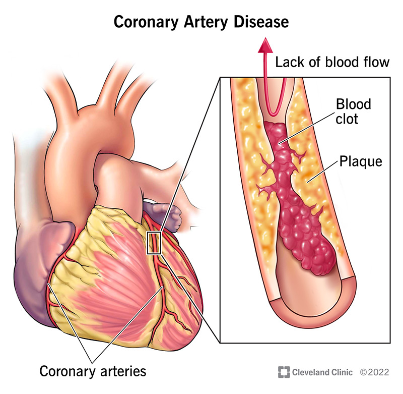 <ul><li><p>Coronary arteries supply blood, oxygen and nutrients to the heart itself since the heart has very thick and active muscular walls </p></li><li><p>Blocked coronary arteries: prevents the cardiac muscle from getting enough energy for it to contract, which means the heart muscle can be damaged and may die</p></li><li><p>CHD occurs when the coronary arteries can’t supply enough oxygen rich blood to the heart because of a blockage in them</p><ul><li><p>The blockages reduce the diameter of the artery, making it difficult for blood to pass through</p></li></ul></li></ul><p></p>