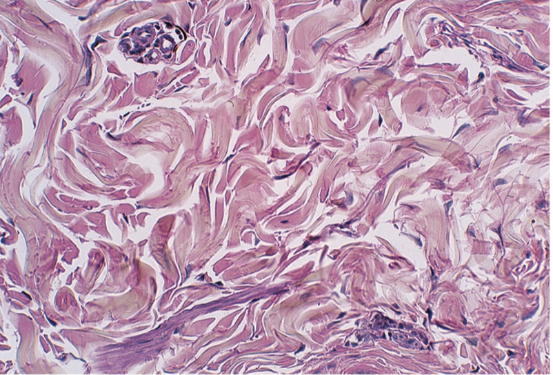 <p>Dense irregular connective tissue</p>