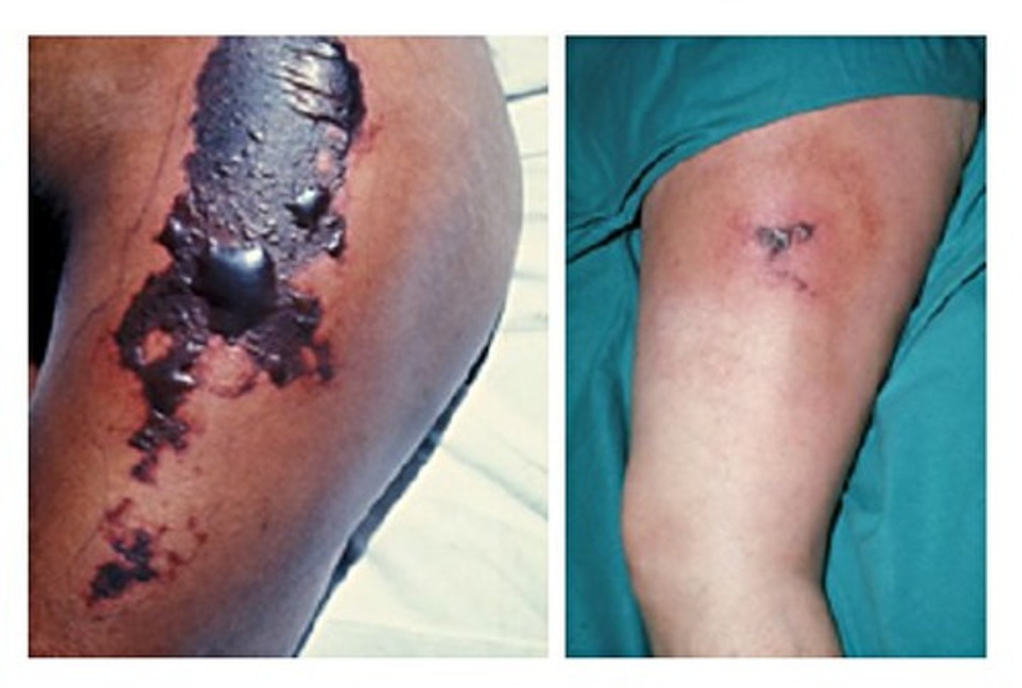 <p>- due to protein C deficiency which is exacerbated</p><p>- protein C deficiency can be acquired or inherited</p><p>1) stop warfarin, start heparin</p><p>2) give vitamin K</p><p>3) If needed, proceed to Protein C concentrate or FFP which has protein C</p>