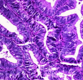 ### Hyperplasia - *Endometrial*