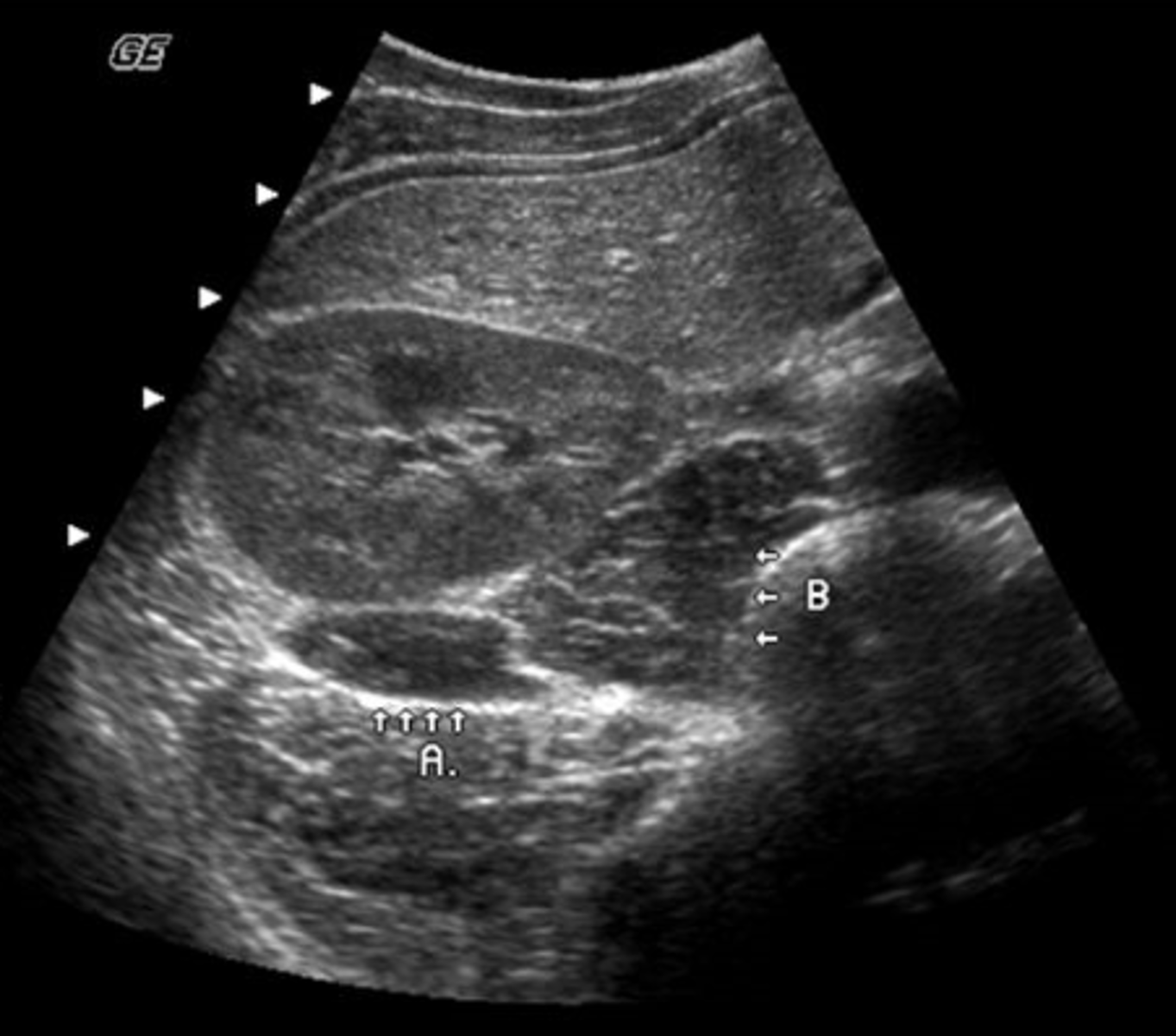 <p>This TRV image was obtained in a 49 y.o. male with hematuria. What structure is represented by the letter "a"?</p><p>a. rib</p><p>b. lumbar spine</p><p>c. quadratus lumborum muscle</p><p>d. psoas muscle</p><p>e. obturator internus muscle</p>