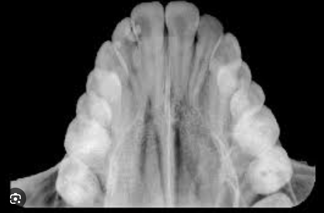 <p>what are occlusal xrays?</p>