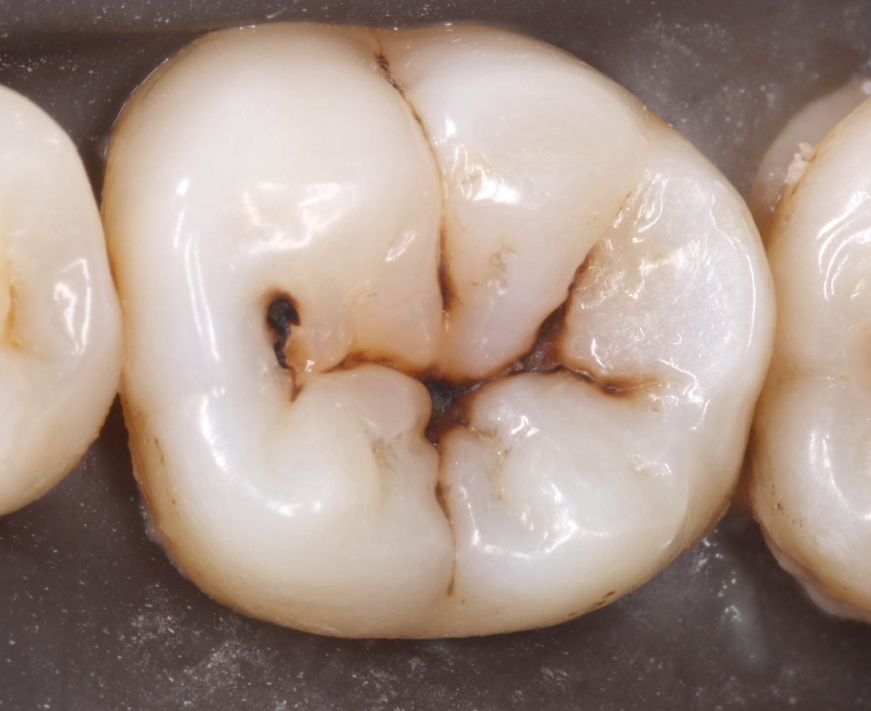 <p>Occlusal of posterior teeth</p><p>or lingual pit near cingulum</p><p>in maxillary incisors</p>