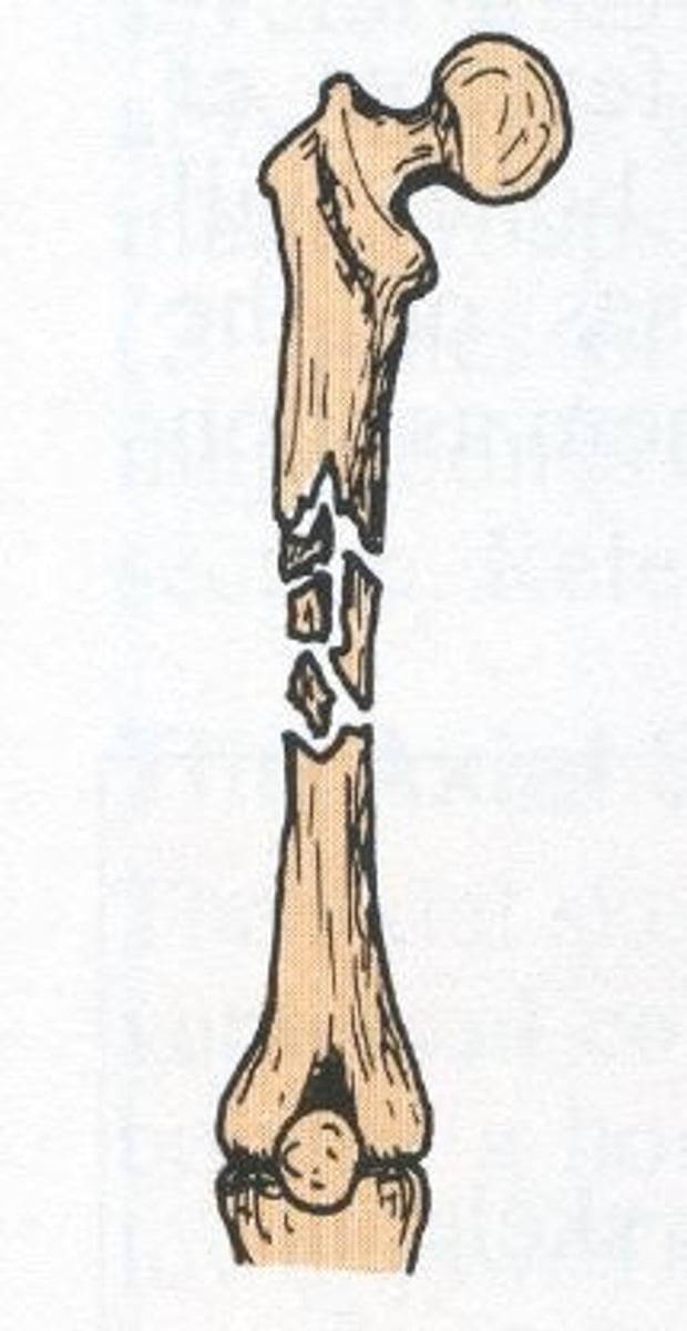 <p>fracture in which the bone is splintered or crushed; breaks into many fragments</p>