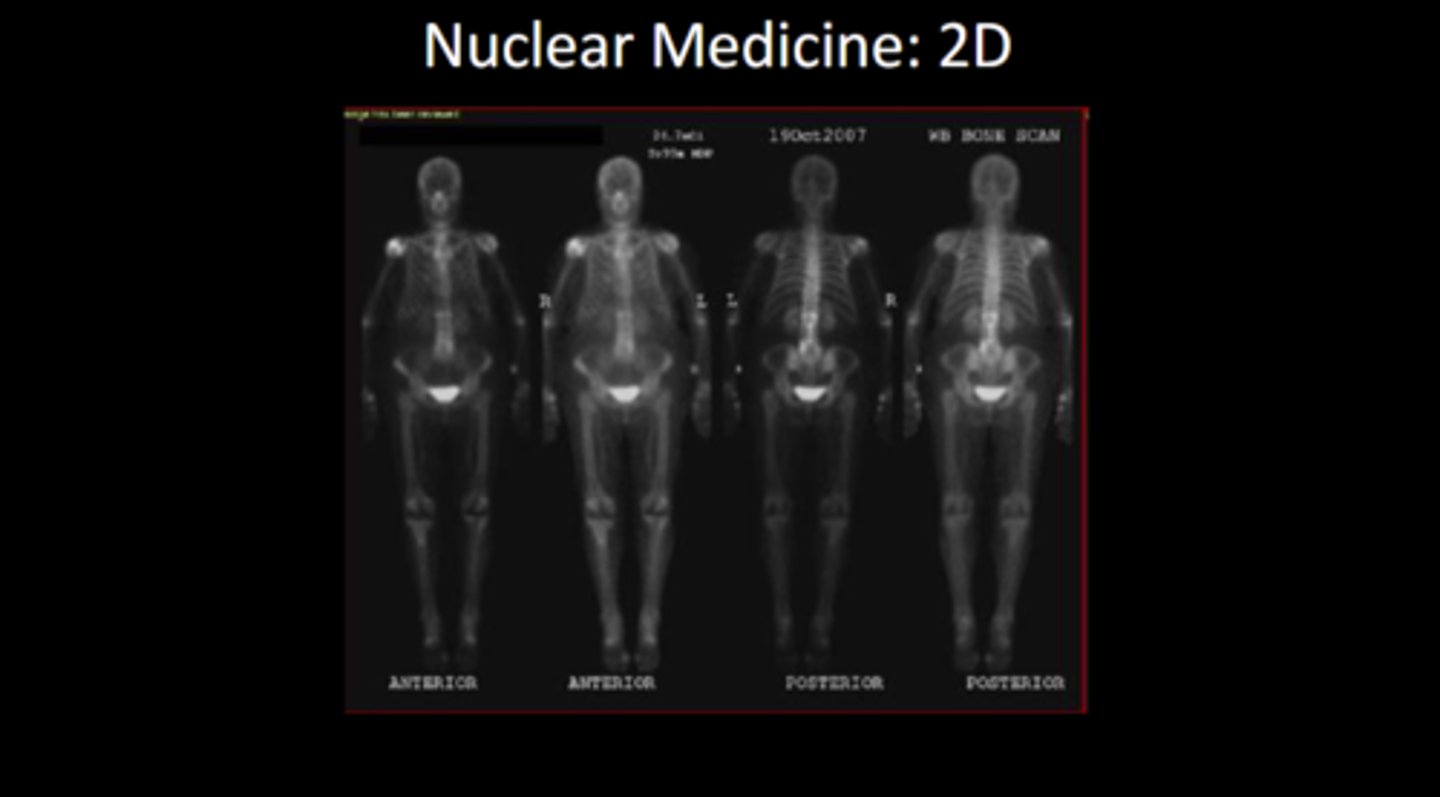 <p>bladder is highlighted because that is how the body excretes the radiopharmaceutical. right shoulder is also highlighted as the injection site</p>