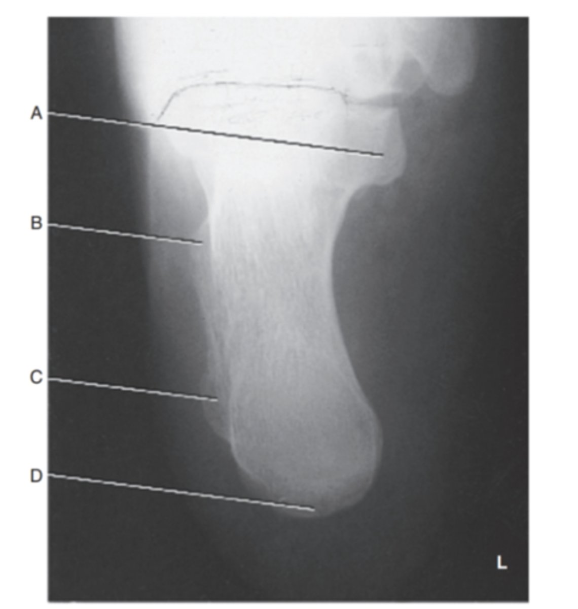 <p>(Axial Plantodorsal calcaneus) what is A?</p>