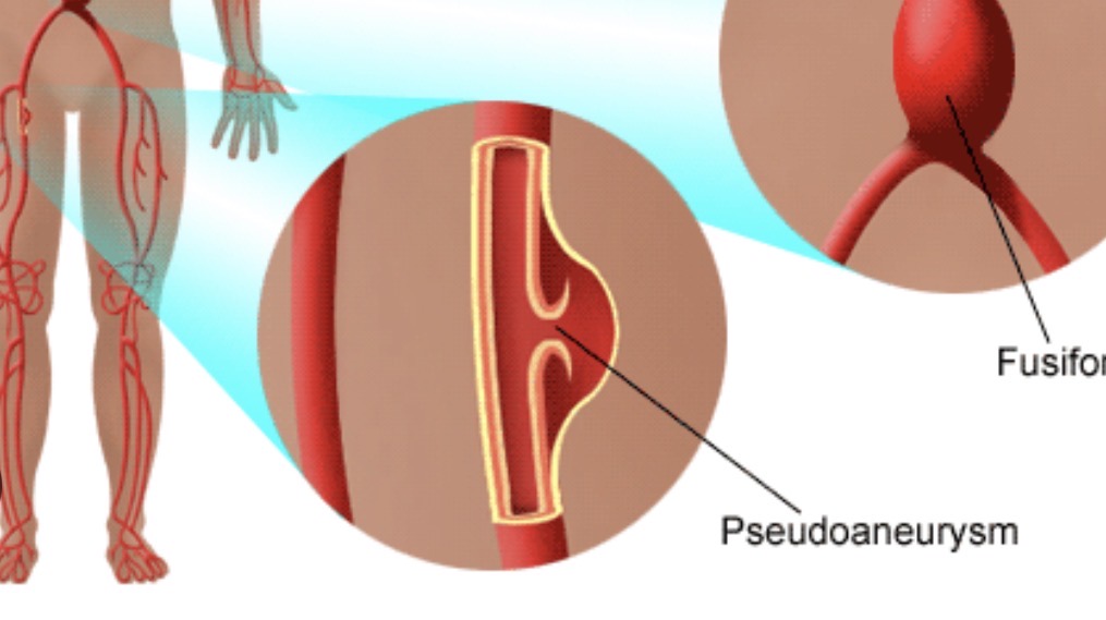 <p>Aortic Pseudoanuerysm</p>