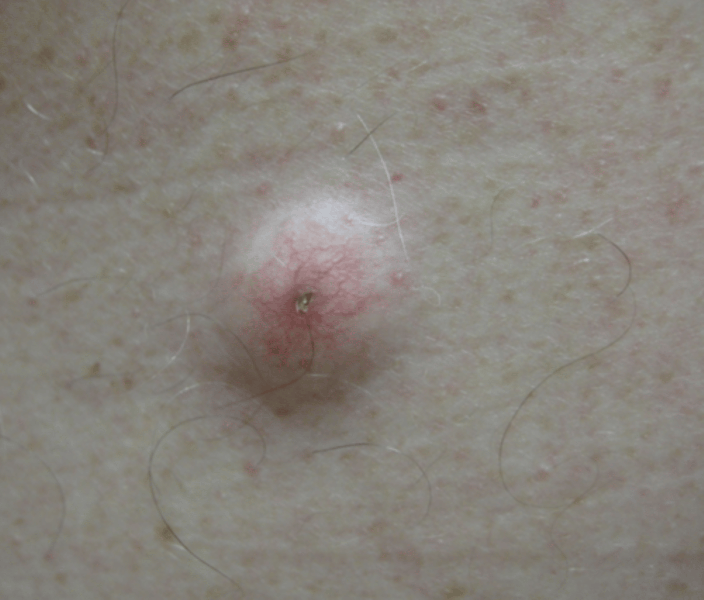 <p>What is the most common cutaneous cyst?</p>