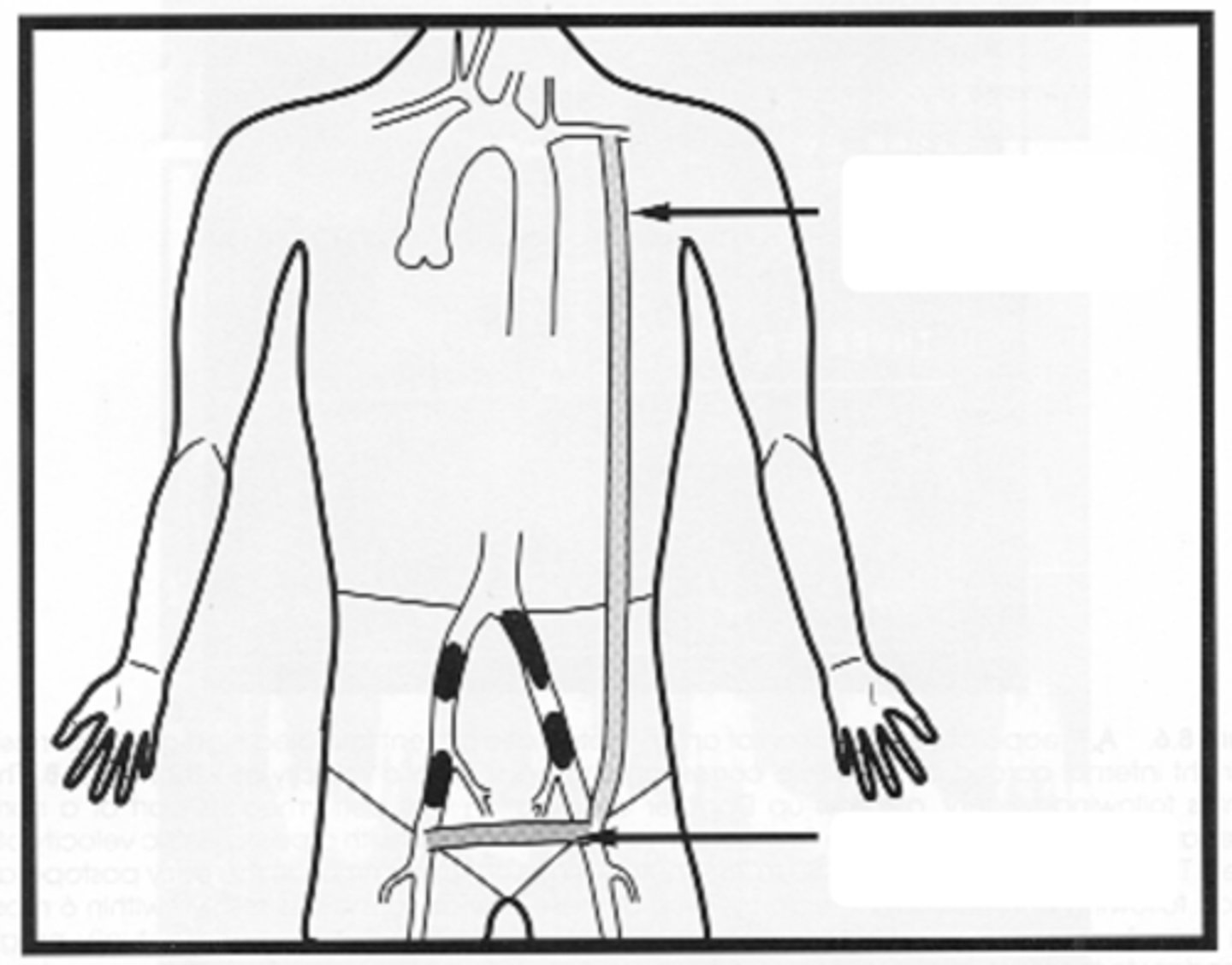 <p>Longest graft type</p><p>Femoral-femoral bypass supplies opposite leg</p>