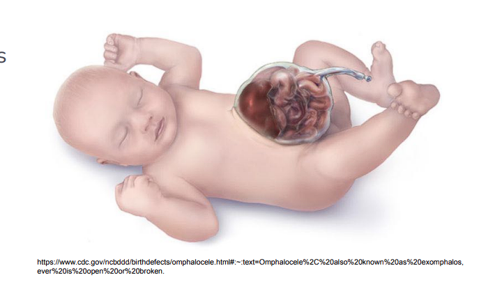 ● Congenital abnormality where  the abdominal contents  protrude through the umbilicus  while remaining in the  peritoneal sac.  

● Occurs during weeks 9-10 of gestation.  

● Usually diagnosed on a  prenatal ultrasound.  
