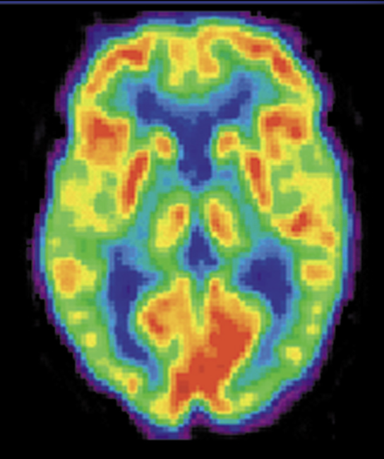 <ul><li><p>High resolution of the brain is obtained&nbsp;</p></li><li><p>Radioactive chemicals (marker) injected into the blood&nbsp;</p></li><li><p>Relationship between the density signal of that marker and the blood flow in that area&nbsp;</p></li><li><p>Color of the image indicates the level of activity&nbsp;</p><ul><li><p>RED most active, followed by yellow, green, blue for least active&nbsp;</p></li></ul></li><li><p>Involves taking dose of radiation </p></li></ul><p></p>
