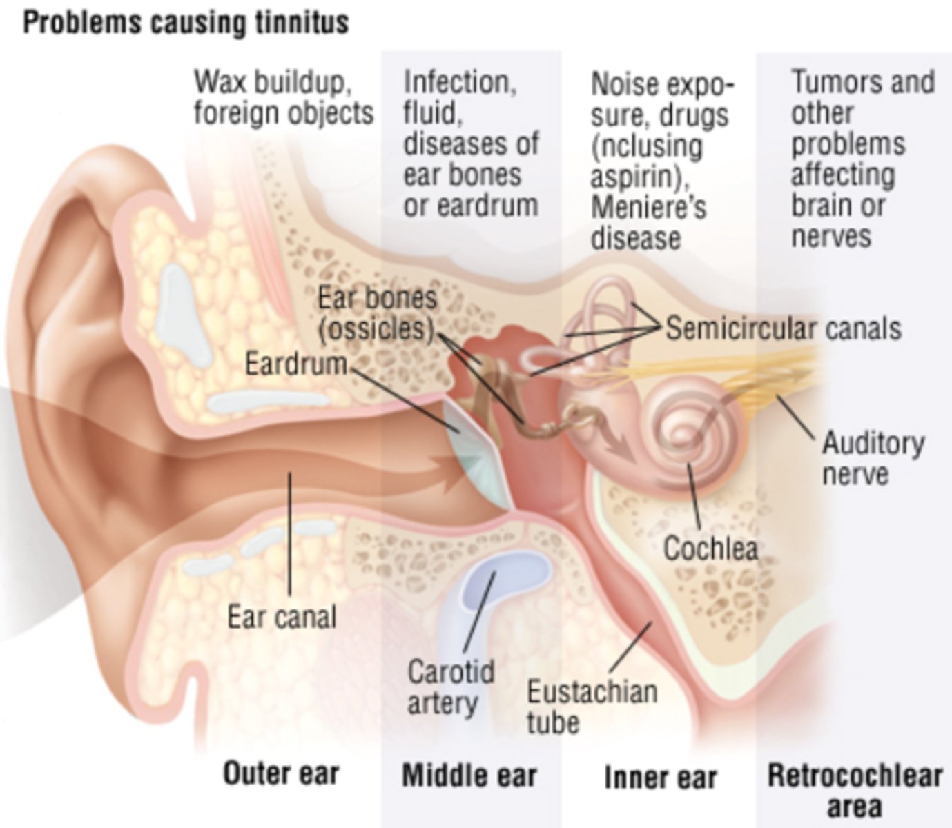 <p>Perception of non verbal sound in ears without a stimulus </p><p>Note that this is a SYMPTOM</p><p>The sound could be (whistling, hissing, buzzing, ringing, pulsating)</p><p>It can be unilateral or bilateral, acute or chronic, and intermittent or constant.</p><p>Frequently is associated with hearing loss and presbyacusis </p>