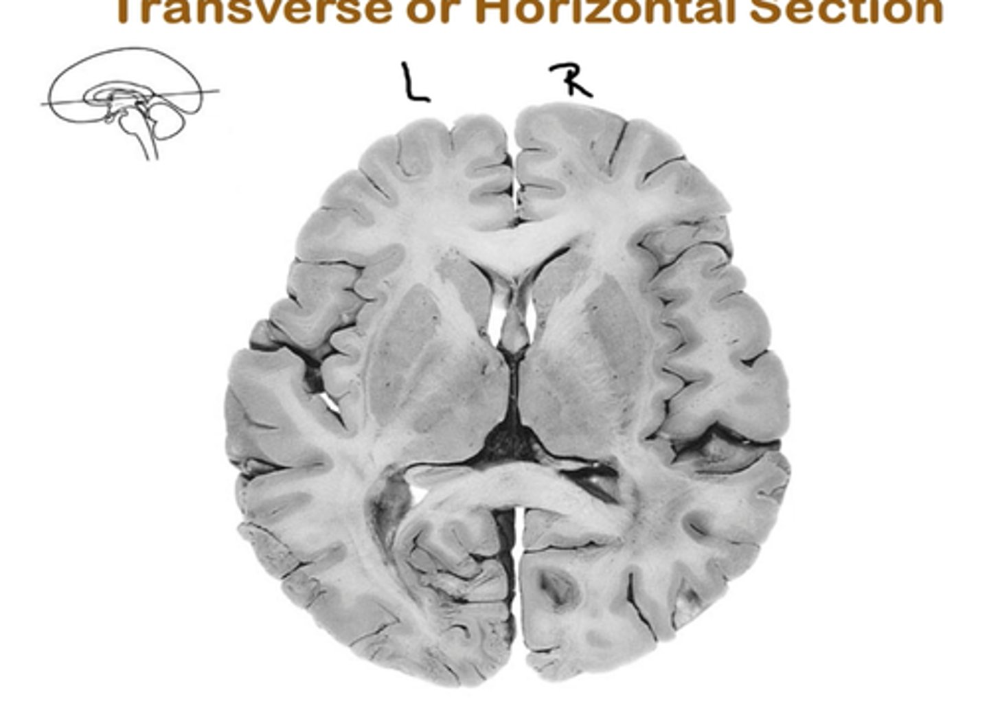 <p>plane forms a view from the top or bottom of the brain</p>