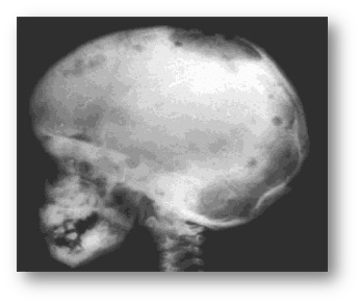 <p>patient's radiograph shows multiple, defined, radiolucent areas with irregular outlines-punched out lesions in the skull. In the alveolar bone, there is saucer-shaped destruction/scooping out of alveolar process that make the teeth appear to be floating in space. Patient is young but experiences abnormal tooth mobility and tooth loss. What is the diagnosis?</p>