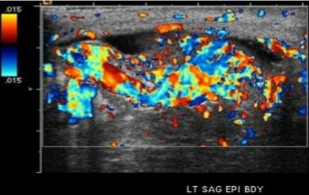 <ol><li><p>This scan was performed on a patient who currently has an infection at the testicles. What can be assumed here?</p></li><li><p>What sonographic finding can be seen here?</p></li></ol><p></p>