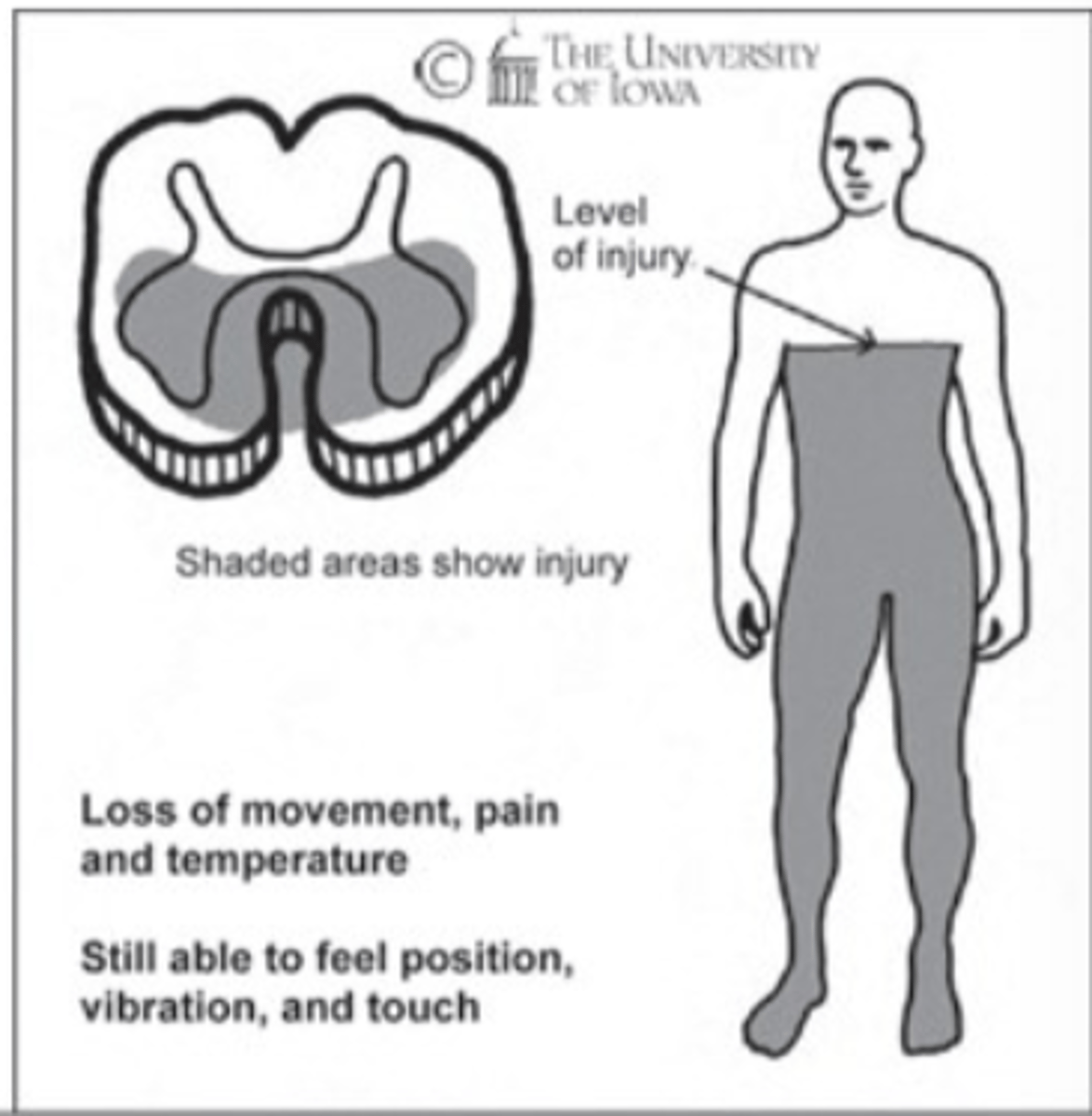 <p>This image depicts the damage associated with which Incomplete SCI Syndrome?</p>