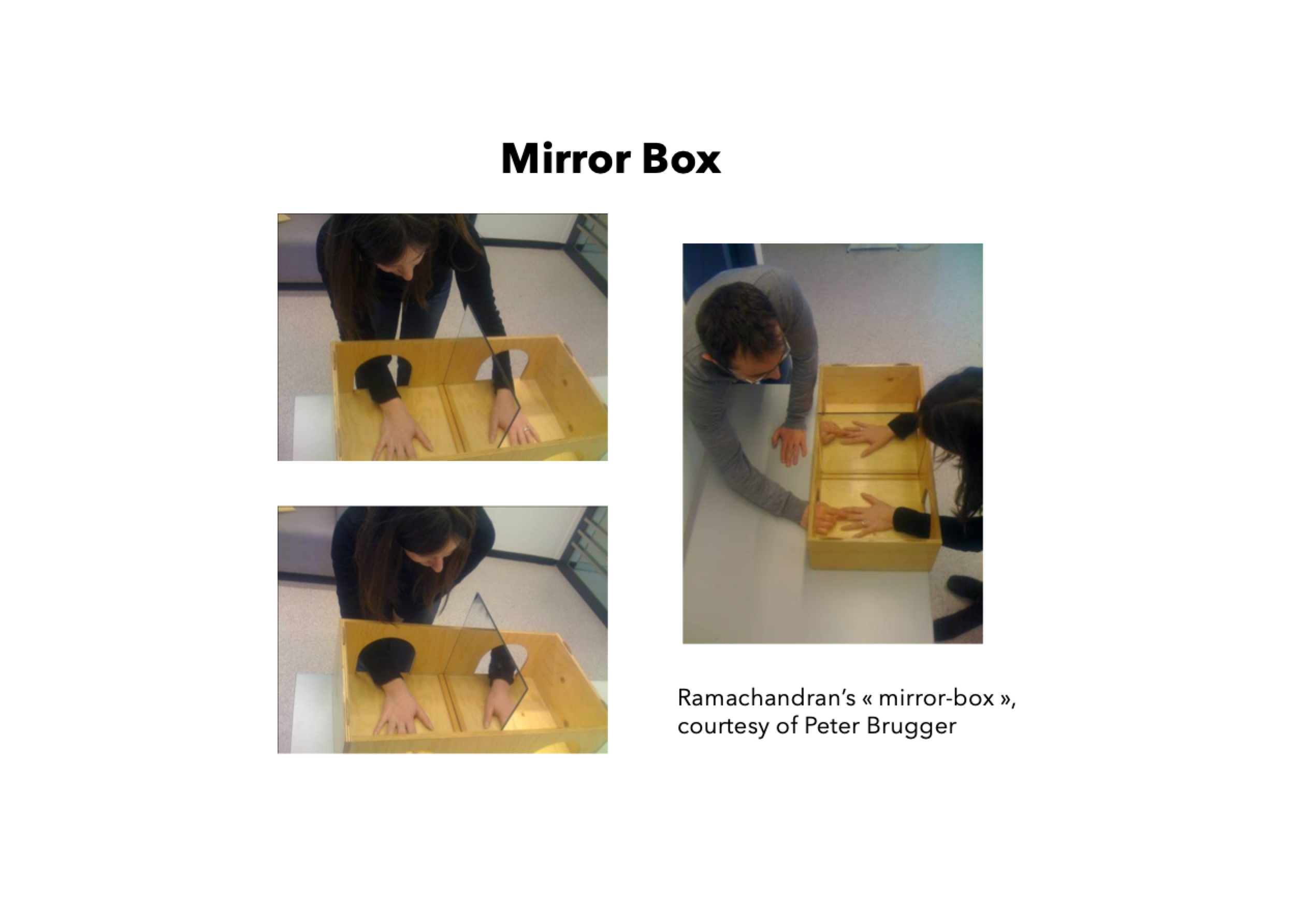 <p class=""><strong>Kurzfassung:</strong><br>Die <strong>Spiegelbox</strong> nutzt die Spiegelung des intakten Arms, um dem Gehirn die <strong>Illusion einer Bewegung des Phantomarms</strong> zu vermitteln, was <strong>Phantomschmerzen lindern kann</strong>, besonders bei wahrgenommenen Verkrampfungen.</p><div data-type="horizontalRule"><hr></div><p class=""><strong>Langfassung:</strong></p><ul><li><p class=""><strong>Aufbau & Anwendung:</strong></p><ul><li><p class="">Ein <strong>Spiegel</strong> steht <strong>senkrecht zwischen den Armen</strong></p></li><li><p class="">Die <strong>Spiegelung des intakten Arms</strong> erscheint an der Stelle des fehlenden Arms</p></li><li><p class="">Durch Bewegung des intakten Arms sieht die Person scheinbar den <strong>Phantomarm bewegt</strong></p></li></ul></li></ul><p class=""></p><ul><li><p class=""><strong>Wirkmechanismus:</strong></p><ul><li><p class="">Das Gehirn verarbeitet die <strong>visuelle Information</strong> so, als sei der <strong>Phantomarm real und beweglich</strong></p></li><li><p class="">Dies kann das Gefühl von <strong>Lähmung oder Verkrampfung</strong> im Phantomglied auflösen</p></li><li><p class="">Besonders effektiv bei Patienten, die ihren Phantomarm als <strong>versteift oder schmerzhaft blockiert</strong> erleben</p></li></ul></li></ul><p class=""></p><ul><li><p class=""><strong>Neurokognitive Grundlage:</strong></p><ul><li><p class="">Die Methode nutzt die <strong>Integration von visuellen, propriozeptiven und motorischen Reizen</strong></p></li><li><p class="">Sie verändert dadurch das <strong>Körperbild im Gehirn</strong> (body schema)</p></li><li><p class="">Beleg für die <strong>Beeinflussbarkeit der Körperrepräsentation durch sensorische Täuschung</strong></p></li></ul></li></ul><p class=""></p><ul><li><p class=""><strong>Bedeutung:</strong></p><ul><li><p class="">Zeigt, wie <strong>top-down-Verarbeitung und multisensorische Integration</strong> genutzt werden können, um chronischen Schmerz zu behandeln</p></li><li><p class="">Klinisch relevante Methode zur <strong>nicht-invasiven Schmerztherapie</strong> bei Amputierten</p></li></ul></li></ul><p></p>