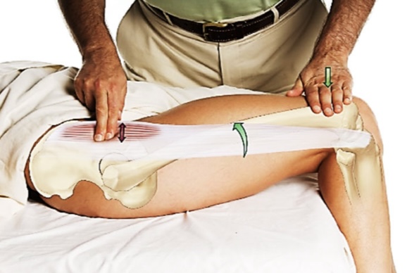 <p>tensor fascia latae (TFL)</p>