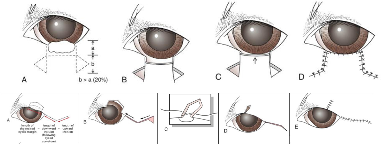 <ol><li><p> If &lt; 30% of eyelid margin: V/ house-shaped mass removal align margin with figure-8 modified cruciate suture, then close remaining skin partial thickness in simple interrupted pattern 2-4mm apart</p></li><li><p>If &gt; 30% of lower eyelid margin: H-plasty pedicle advancement flap. Suture conjunctiva and skin at the new lid margin with a simple continuous pattern and try to align so no growing hairs will touch the eye. Place interrupted sutures to oppose the remaining incision.</p></li><li><p>If &gt; 30% of upper eyelid margin: Semi-circular flap. Remove mass, make a lateral semicircular incision (length of curve x2 the excised portion, where peak of curve is middle of incision). At the lateral end of the incision, excise a triangle area, advance the skin flap and close with figure-8 suture. Oppose the skin of new lateral canthus with the peak using figure-8 suture. Close skin with simple interrupted.</p></li></ol><p></p>