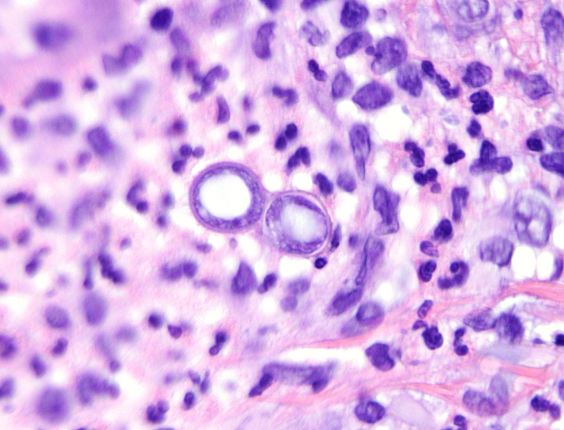 <p>Fungal respiratory infection caused by blastomyces dermatitis (dimorphic fungus). Found in Ohio and missispipi river valleys and Eastren U.S.</p>