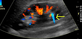 <ul><li><p>reverberation artifact</p></li><li><p>similar to comet tail but with color</p></li><li><p>useful in identifying kidney stones</p></li></ul>