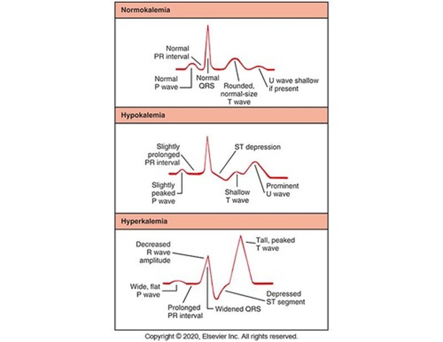 <p>Potassium level &lt;3.5 mEq/L with manifestations depending on heart rate and severity.</p>