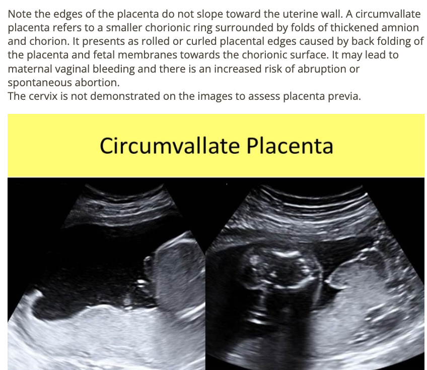 <p>b) circumvallate placenta</p>